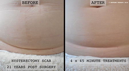 before and after pictures of scar work